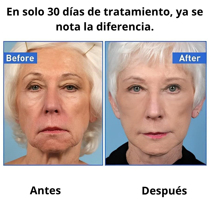 Suero Facial Botox- 2 unidades