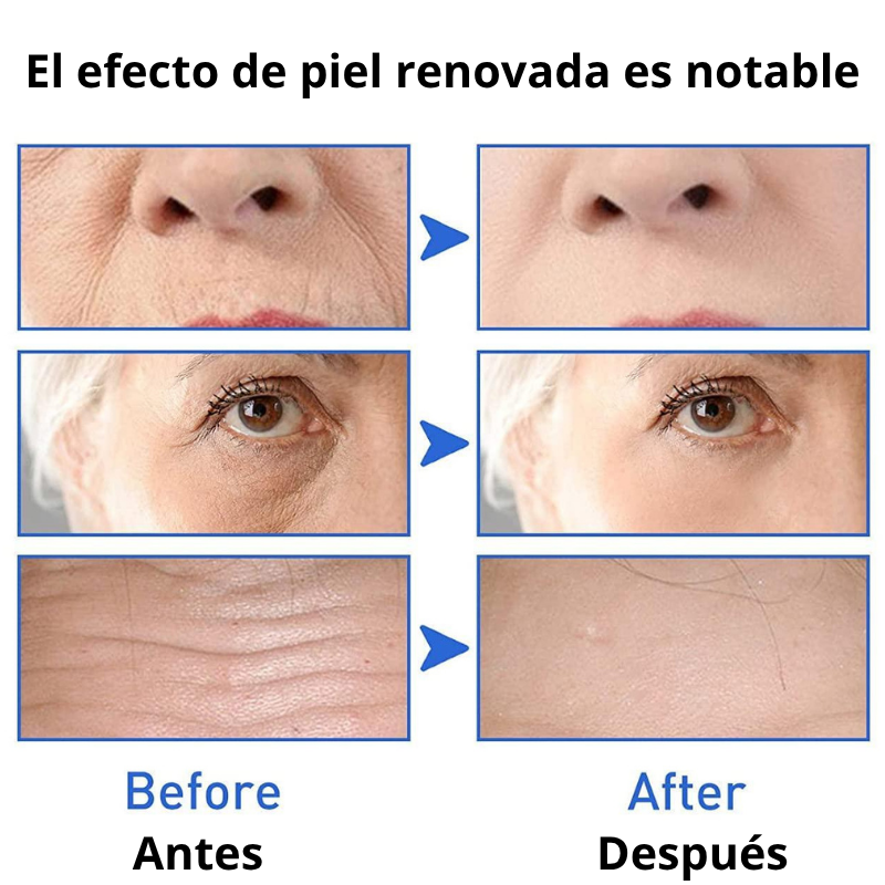 Suero Facial Botox- 2 unidades